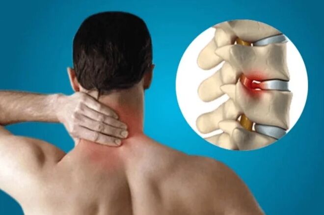 Osteochondroza páteře