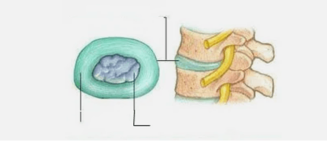 Povaha osteochondrosy